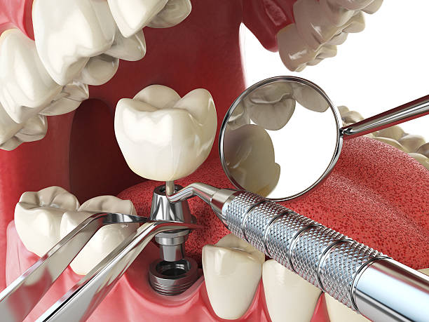 Best Emergency Tooth Extraction in Centereach, NY